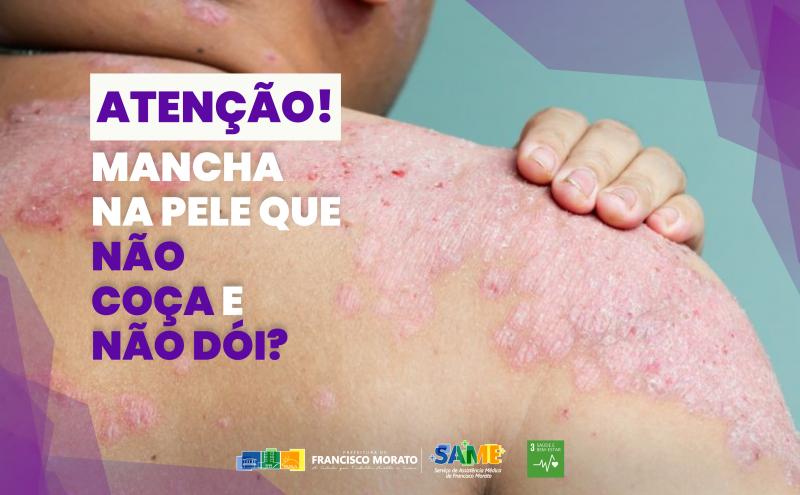 Hanseníase: perceber cedo faz toda a diferença!